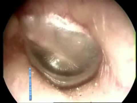 La Micosi dell’Orecchio è Contagiosa? Scopriamo la Verità